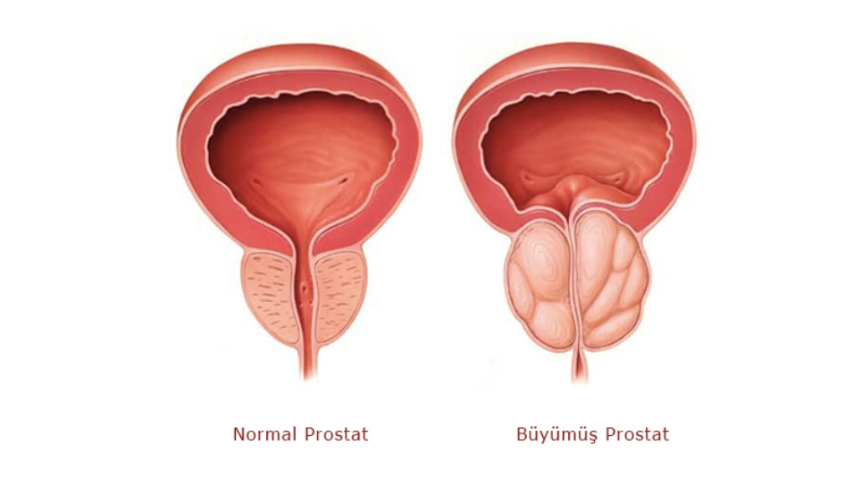 Bursa'da prostat büyümesi (BPH) tedavisi – lazer, TURP ve minimal invaziv çözümler